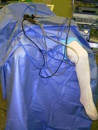 tecnica quirurgica inestabilidad rodilla ligamento cruzado anterior LCA