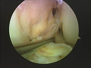 tecnica quirurgica cirugia  inestabilidad rodilla ligamento cruzado anterior LCA