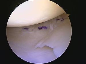 tecnica quirurgica cirugia  inestabilidad rodilla ligamento cruzado anterior LCA