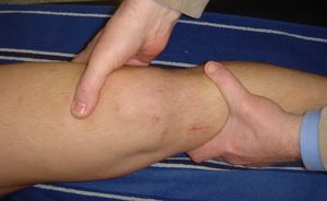 test lachman inestabilidad rodilla ligamento cruzado anterior LCA