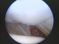 artroscopia tobillo maleolo externo osteocondritis astragalo