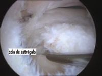 artroscopia tobillo maleolo externo osteocondritis astragalo