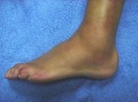 inflamacion ligamentos pie tobillo externo esguince