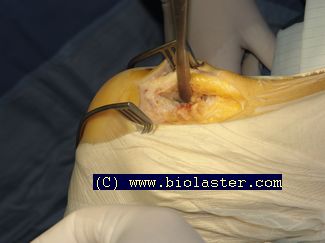 cirugia tendinitis aquuiles haglund