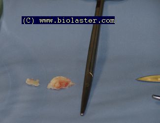 cirugia tendinitis aquuiles haglund