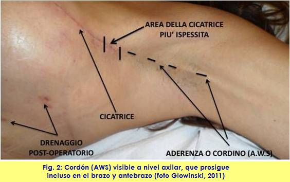 kinesiology taping vendaje neuromuscular linfatico adherencia cicatrizal AWS