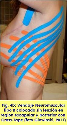 kinesiology taping vendaje neuromuscular linfatico adherencia cicatrizal AWS