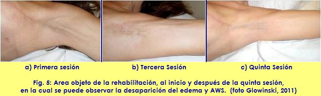 kinesiology taping vendaje neuromuscular linfatico adherencia cicatrizal AWS